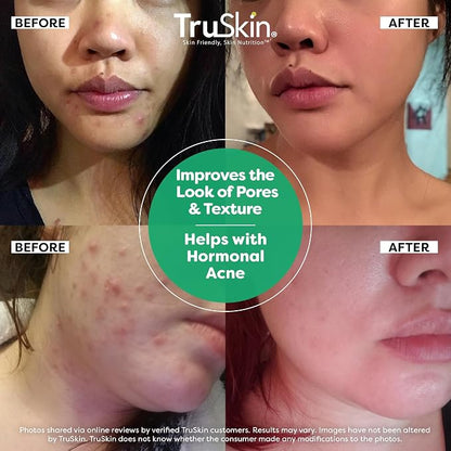 TruSkin Tea Tree Oil Acne Treatment - Image 4